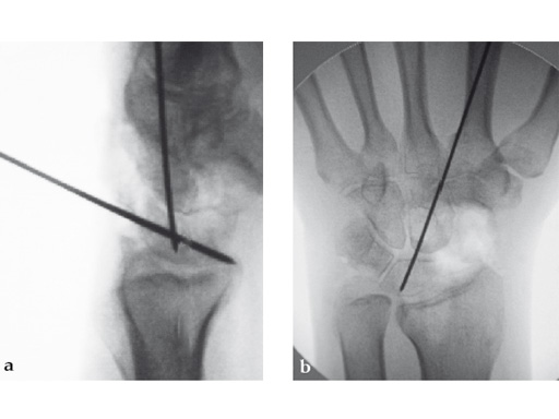 2-4-VA-Locking-Intercarpal-Fusion-System-08