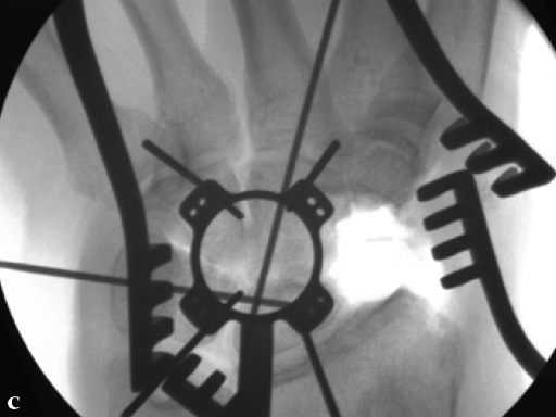 2-4-VA-Locking-Intercarpal-Fusion-System-10