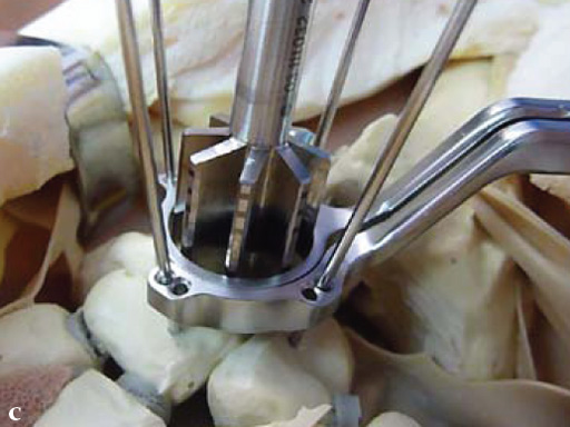 2-4-VA-Locking-Intercarpal-Fusion-System-12