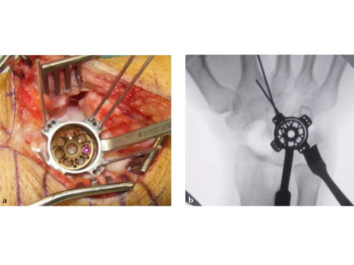 2-4-VA-Locking-Intercarpal-Fusion-System-13