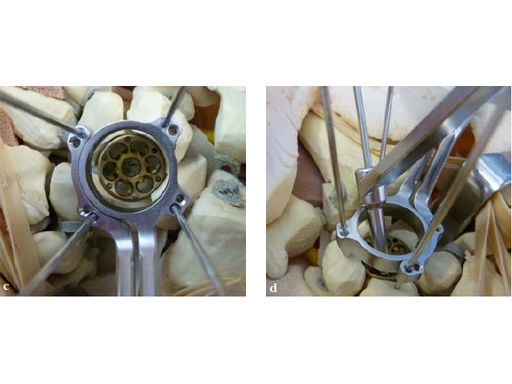 2-4-VA-Locking-Intercarpal-Fusion-System-14