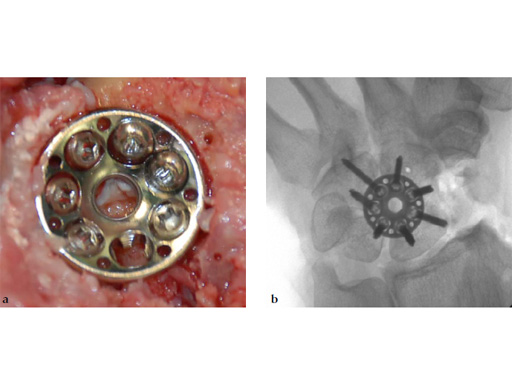 2-4-VA-Locking-Intercarpal-Fusion-System-15