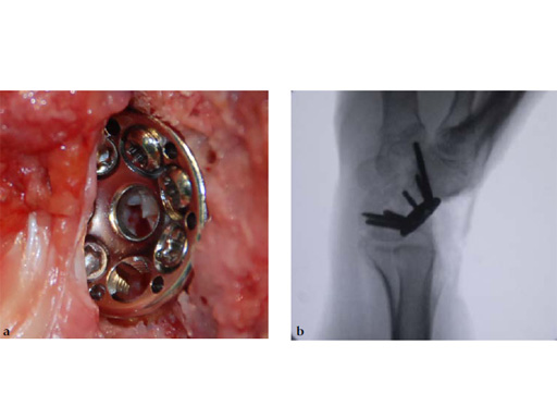 2-4-VA-Locking-Intercarpal-Fusion-System-16
