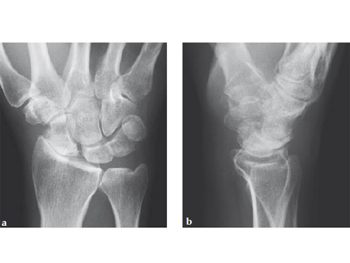 2-4-VA-Locking-Intercarpal-Fusion-System-17