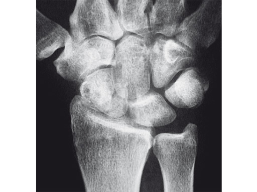 2-4-VA-Locking-Intercarpal-Fusion-System-20