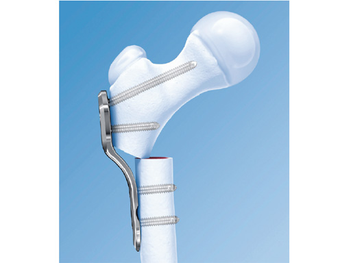 27-2-7-LCP-Pediatric-Hip-Plate-01