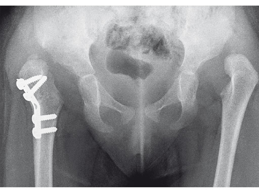27-2-7-LCP-Pediatric-Hip-Plate-04