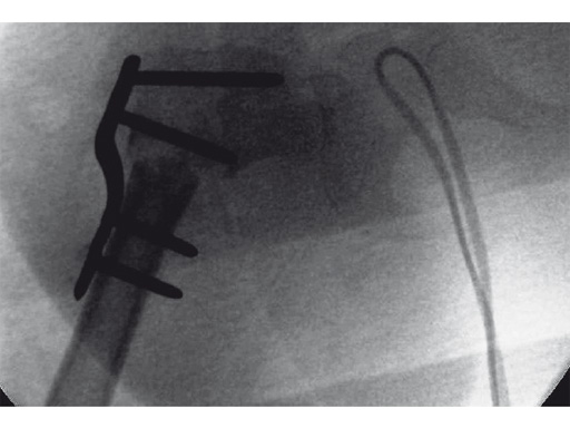 27-2-7-LCP-Pediatric-Hip-Plate-05