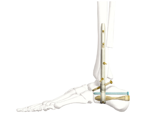 In2Bones Announces the Global Launch of the TriWay® TibioTaloCalcaneal  (TTC) Nail Arthrodesis System | Business Wire