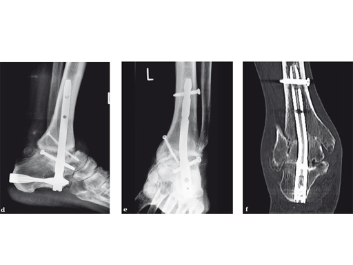 Fibular Intramedullary Nails: Indications, Trends, and Recent Results |  Podiatry Today