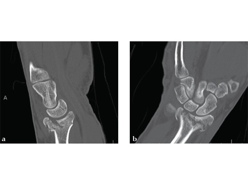 2_4-VA-LCP-Dorsal-Distal-Radius-Plate-05