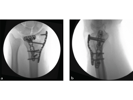 2_4-VA-LCP-Dorsal-Distal-Radius-Plate-06
