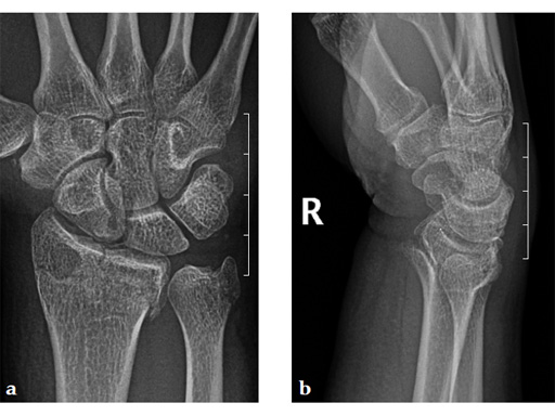 2_4-VA-LCP-Dorsal-Distal-Radius-Plate-08