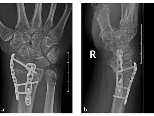 2_4-VA-LCP-Dorsal-Distal-Radius-Plate-11