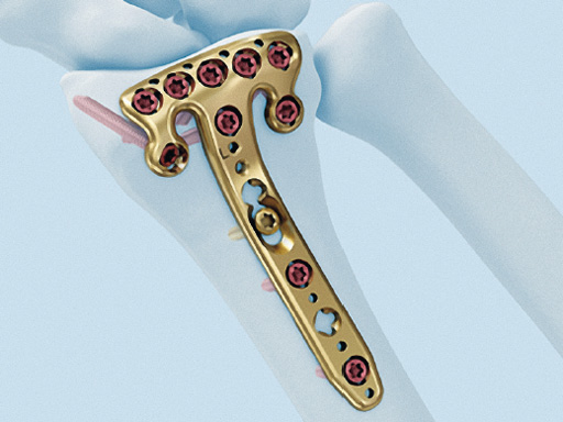 2_4-VA-LCP-Volar-Rim-Distal-Radius-Plate-01