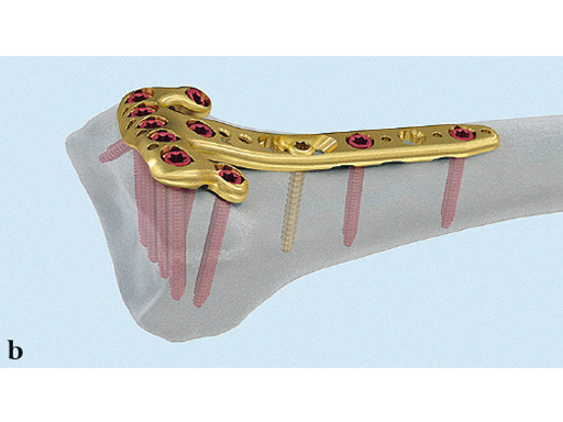 2_4-VA-LCP-Volar-Rim-Distal-Radius-Plate-02