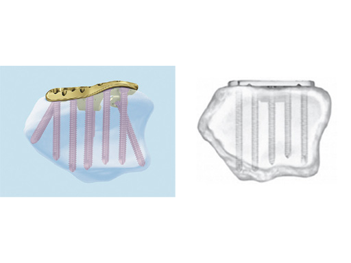 2_4-VA-LCP-Volar-Rim-Distal-Radius-Plate-03-04