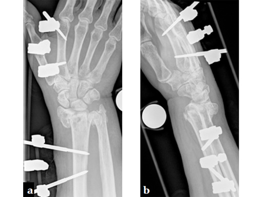 2_4-VA-LCP-Volar-Rim-Distal-Radius-Plate-06