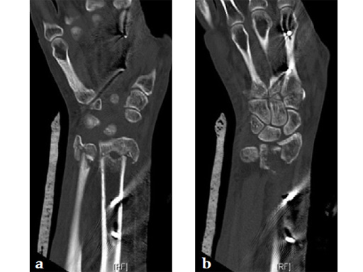 2_4-VA-LCP-Volar-Rim-Distal-Radius-Plate-07