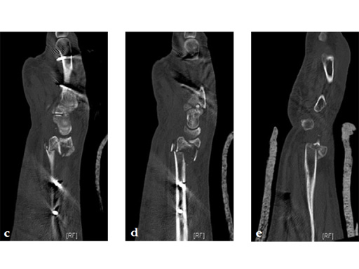 2_4-VA-LCP-Volar-Rim-Distal-Radius-Plate-08