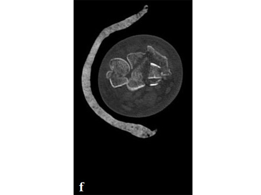 2_4-VA-LCP-Volar-Rim-Distal-Radius-Plate-09