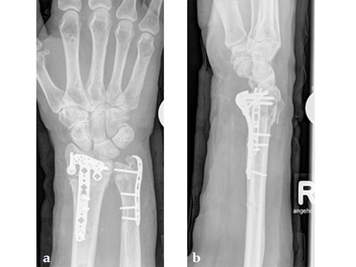 2_4-VA-LCP-Volar-Rim-Distal-Radius-Plate-10