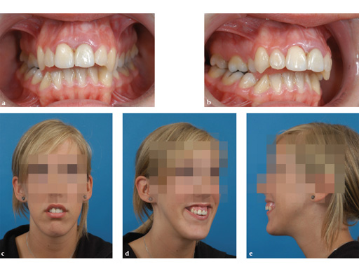 38-Transpalatal-Distractor-system-06