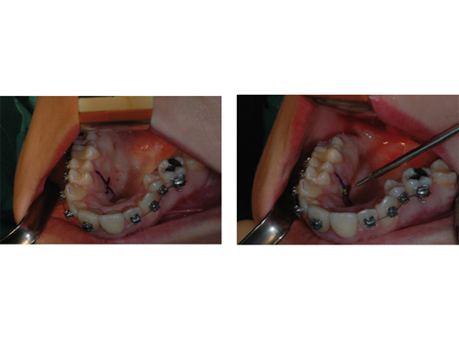 38-Transpalatal-Distractor-system-07