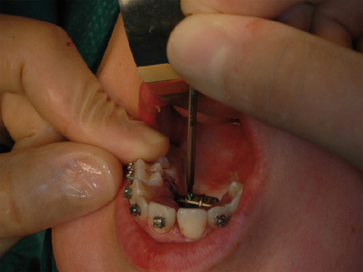 38-Transpalatal-Distractor-system-09