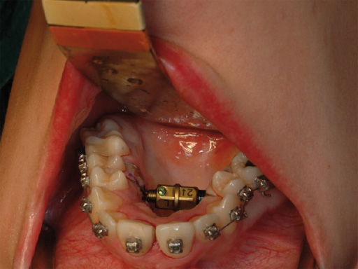 38-Transpalatal-Distractor-system-10