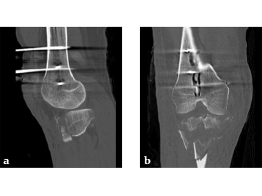 3_5-LCP-Proximal-Tibia-Low-Bend-05