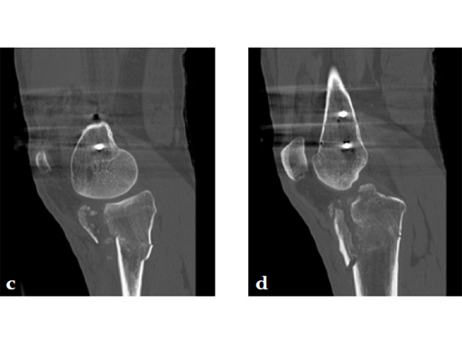 3_5-LCP-Proximal-Tibia-Low-Bend-06