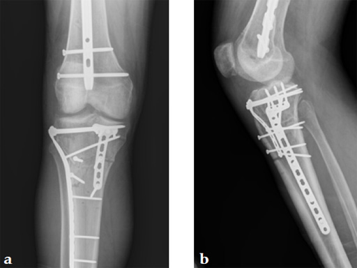 3_5-LCP-Proximal-Tibia-Low-Bend-08