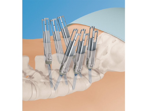 46-Matrix-Deformity-Matrix-MIS-01