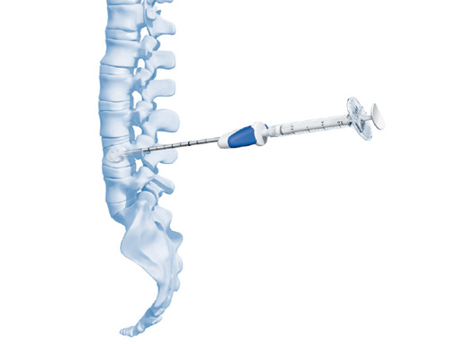 51-VBS-Stentoplasty-Vertecem-03