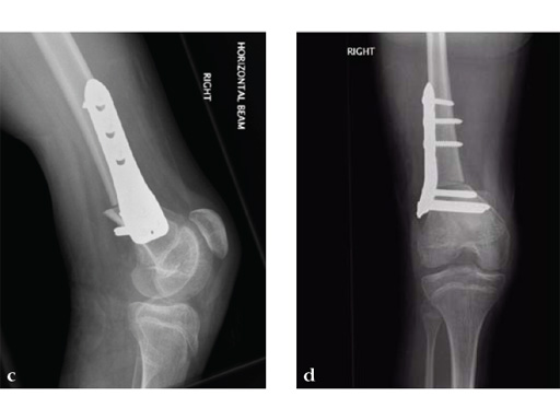 90-3_5-5-0-LCP-Pediatric-Condylar-Plate-05