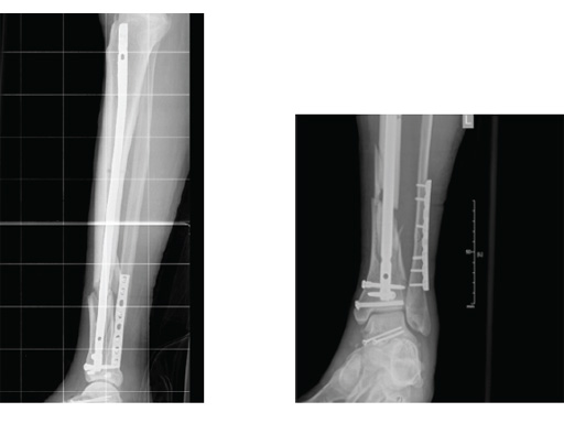 10563825-001, illustration picture of protect tibia of Bruz…