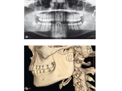 Fracture-Plates-Condylar-Neck-Base-07