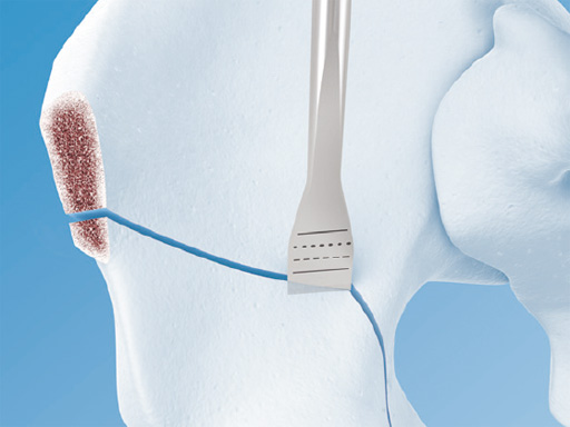 Hip-Preservation-Surgery-Set-01