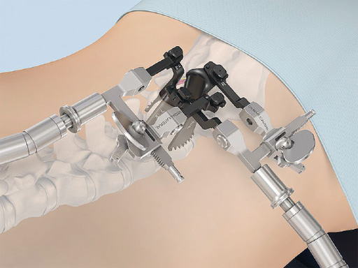 Insight-Retractor-Tube-Systems-01