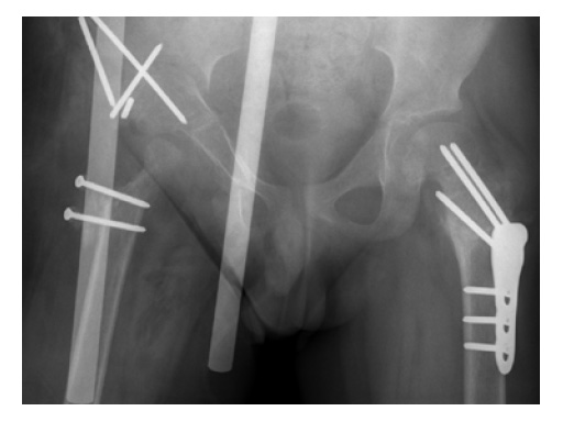 LCP-PHP-140-3_5-5_0-06