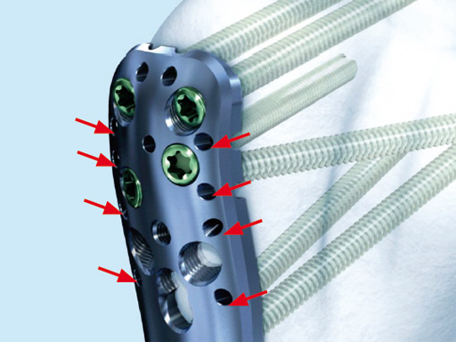 PHILOS-Instrument-Upgrade-02