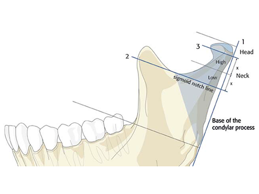 condylar-process