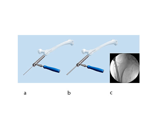 Ex-Nail-Instruments-Fig-4