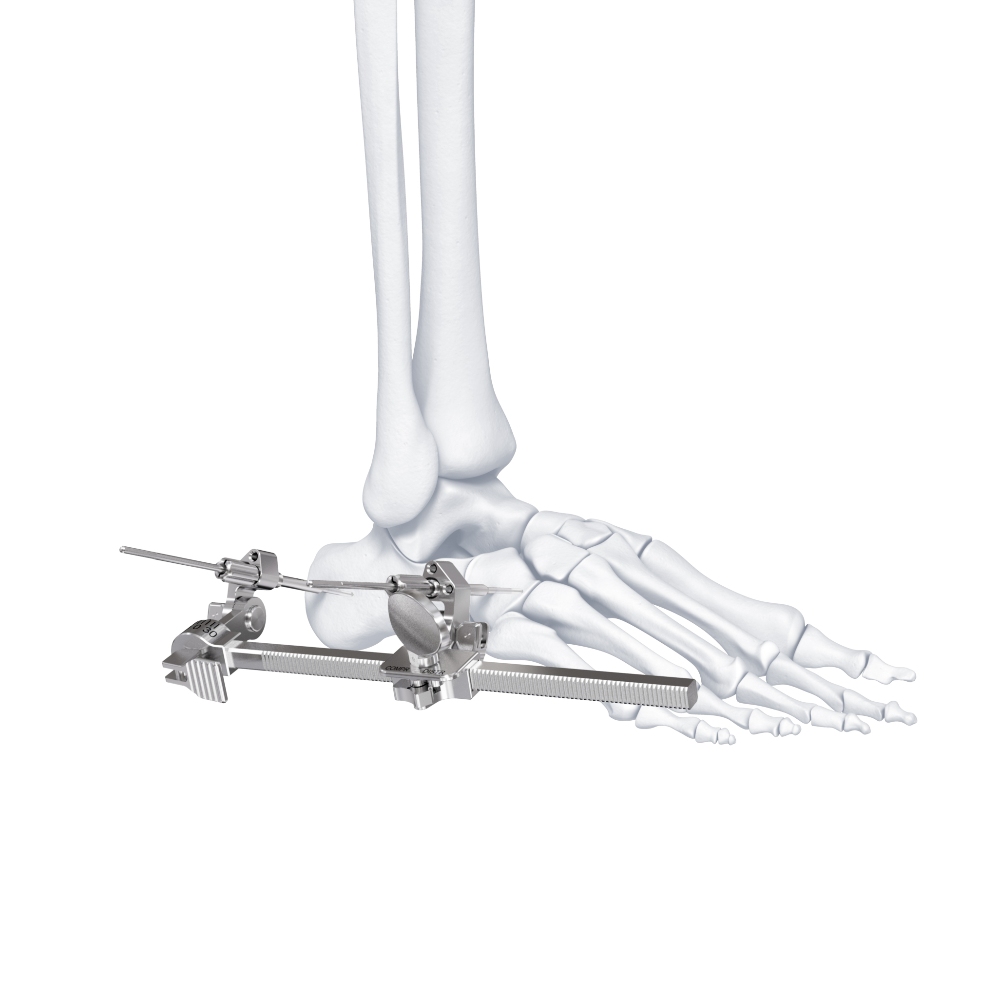 CompressionDistractionDevice