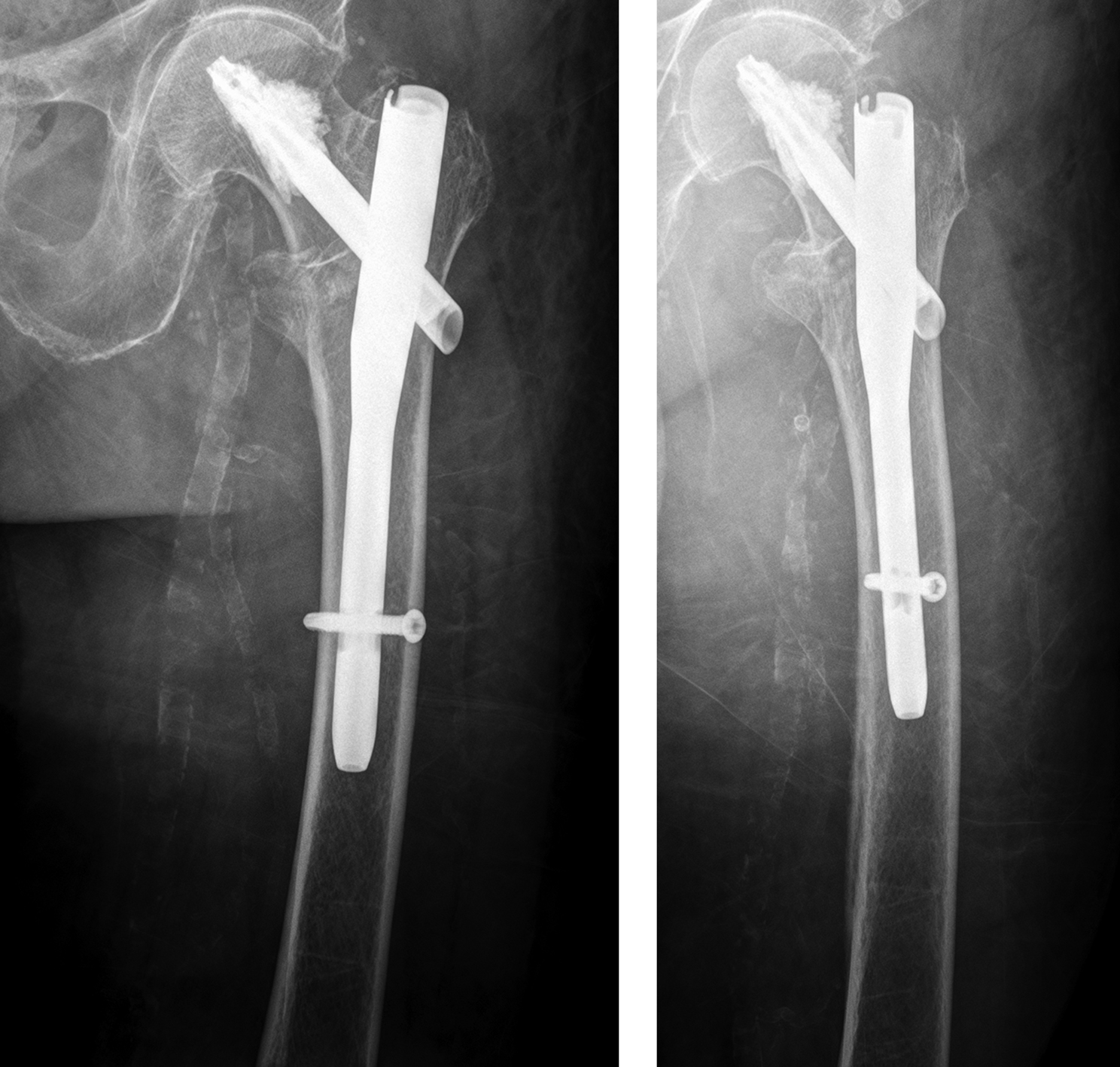 Orthopedic Trauma Implants Surgical Instruments Femoral Gamma Interlocking  Nail System Intertan Nail - China Intramedullary Nail, Surgical Instrument  | Made-in-China.com