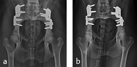 Double Triple Pelvic Osteotomy DPO TPO plate