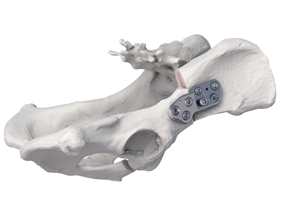 Double/Triple Pelvic Osteotomy (DPO/TPO) plate