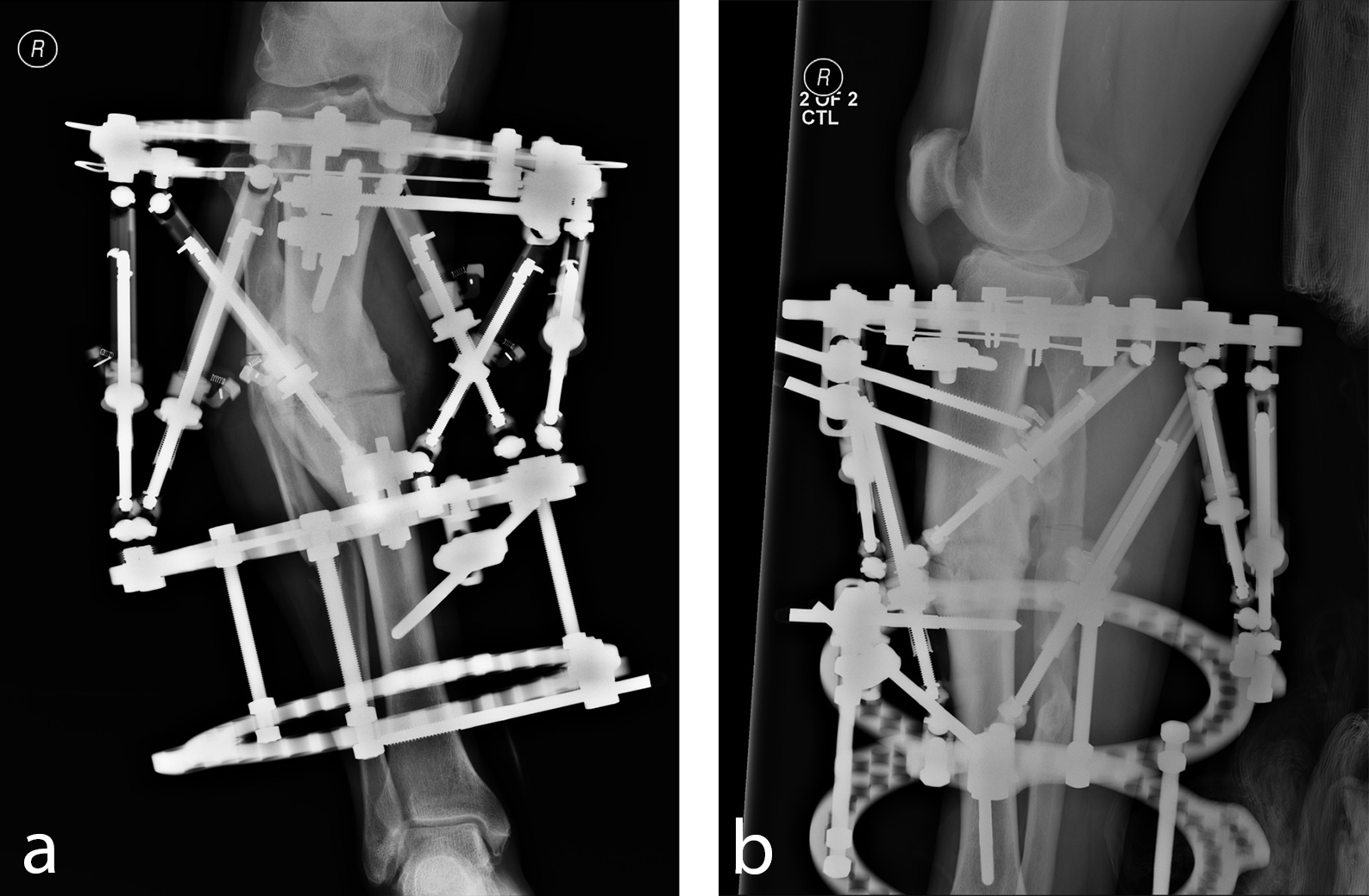 MAXFRAME MultiAxial Deformity Correction System