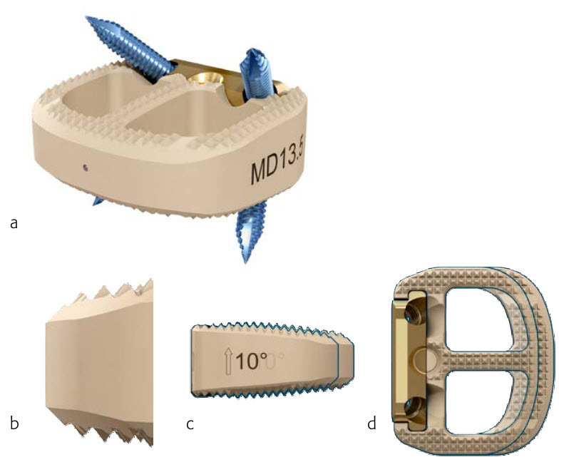 Stand-alone anterior interbody fusion with the Synfix Evolution